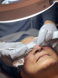 Extraction Facial - Blackhead removal