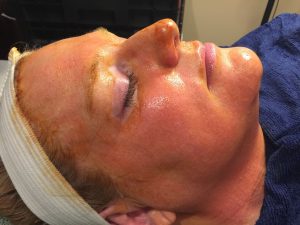Osmosis MD Infusion Facial