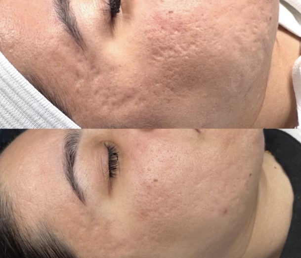 Procell Microchanneling Acne Scar Revision