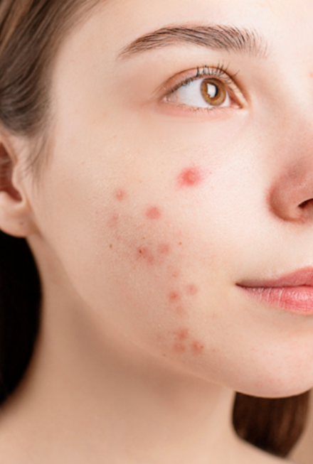 Understanding Acne Cosmetica: Causes, Best Remedies, and the Importance of Skin pH 