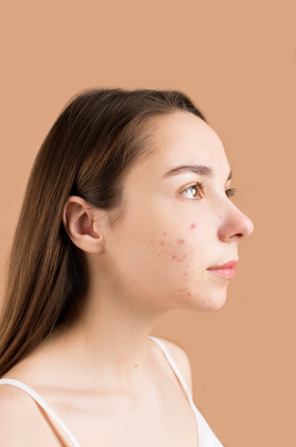 Understanding the Difference Between Breakouts and Purging: A Comprehensive Guide - Skin Care