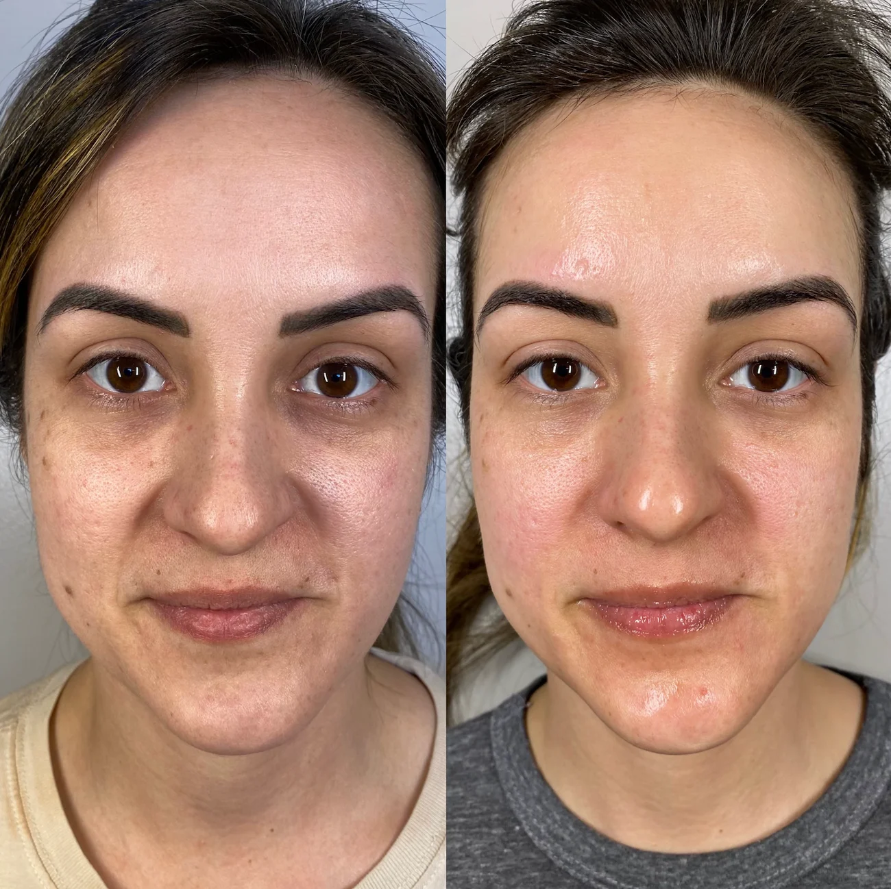 How BioRePeel Can Transform Your Skin in Just One Session