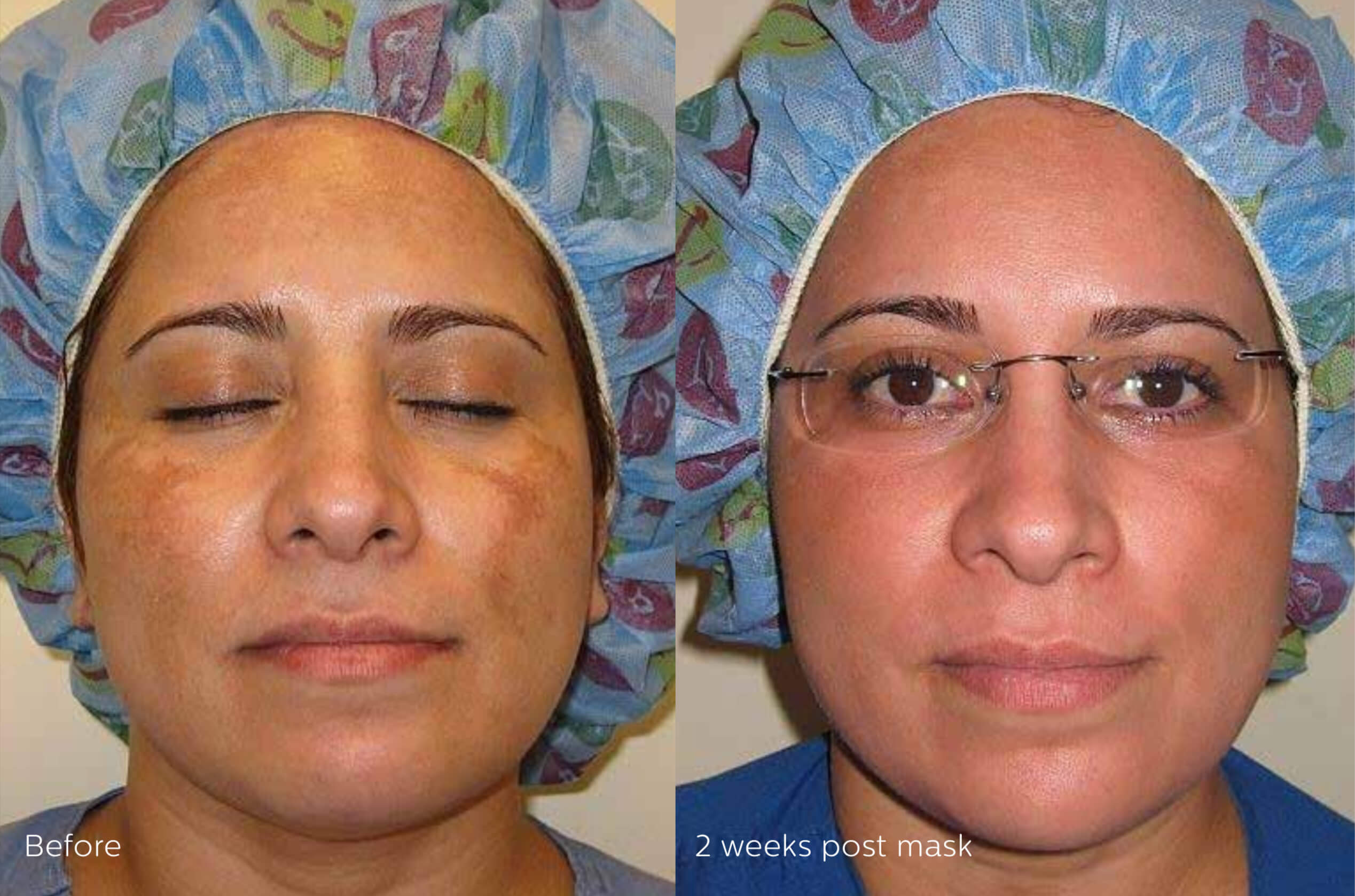 Cosmelan Treatment for Hyperpigmentation