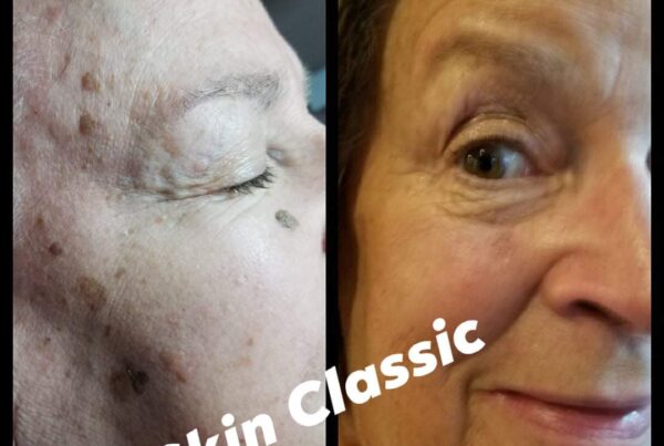 Transform Your Skin with Skin Classic - Skin Care